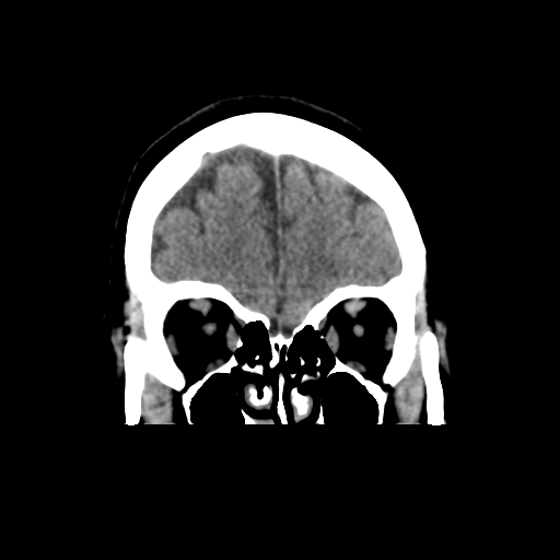 Cerebellar metastasis (cystic appearance) (Radiopaedia 41395-44258 Coronal non-contrast 15).png