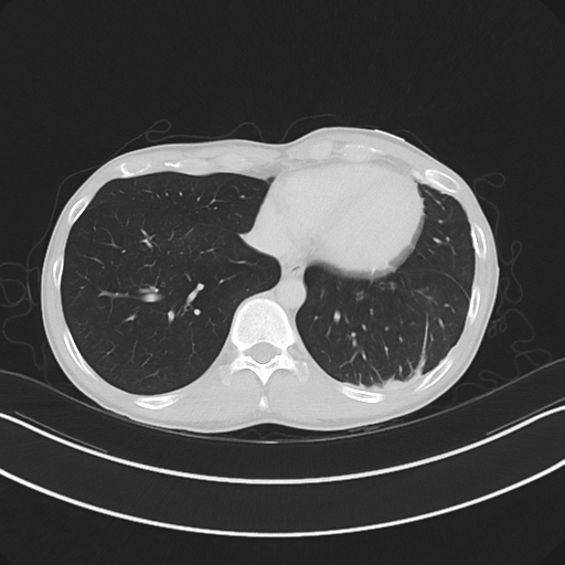 Cerebellar metastasis - adenocarcinoma lung (Radiopaedia 63184-71717 Axial lung window 51).png