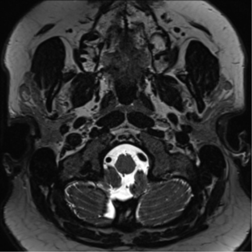 Cerebellopontine angle meningioma (Radiopaedia 48434-53348 Axial T2 Space 4).png