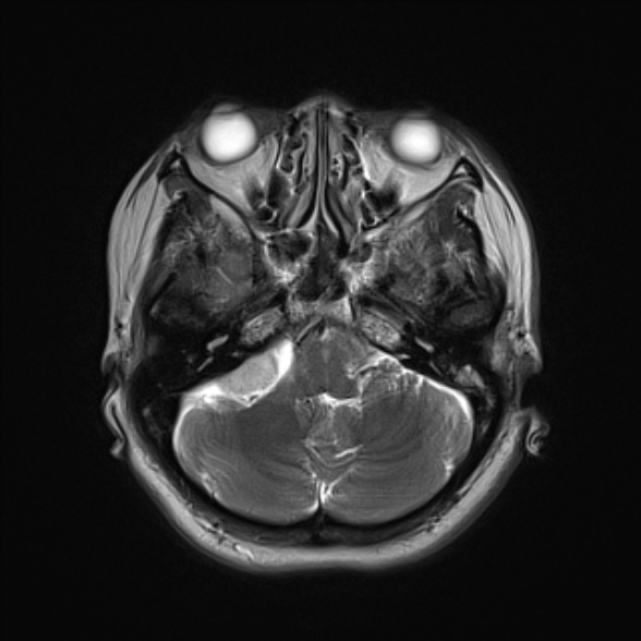 File:Cerebellopontine angle meningioma (Radiopaedia 53561-59591 Axial T2 6).jpg
