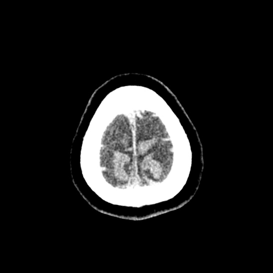 File:Cerebellopontine angle meningioma (Radiopaedia 53561-59592 Axial non-contrast 65).jpg