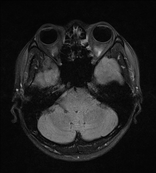 File:Cerebral abscess (Radiopaedia 24212-24478 Axial FLAIR 5).jpg