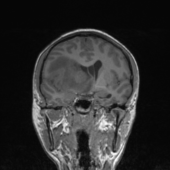 Cerebral abscess (Radiopaedia 24212-24478 Coronal T1 99).jpg