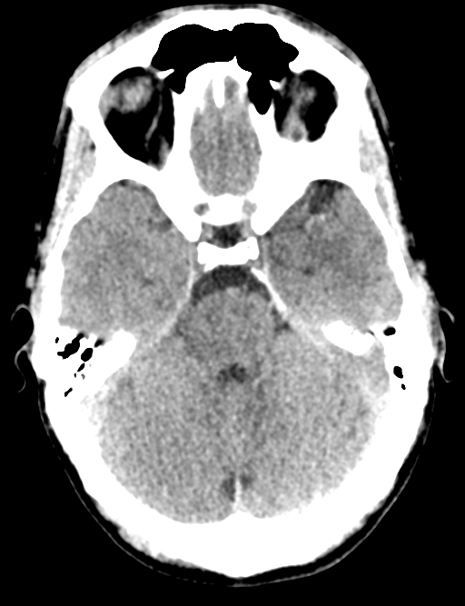 Cerebral abscess (Radiopaedia 60342-68008 Axial non-contrast 17).png