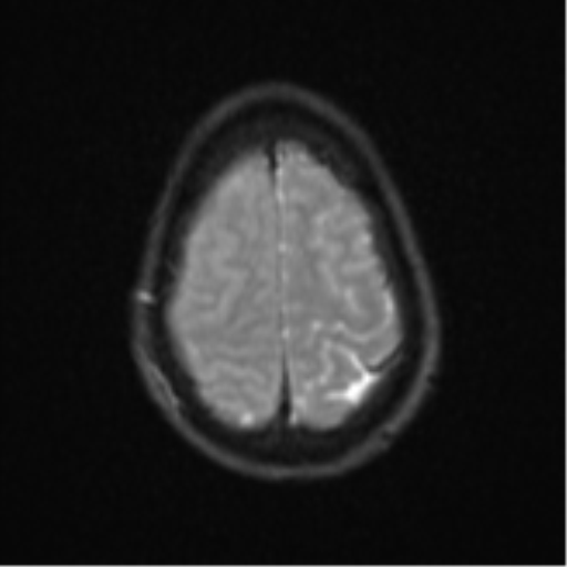 Cerebral abscess (Radiopaedia 60342-68009 Axial DWI 31).png