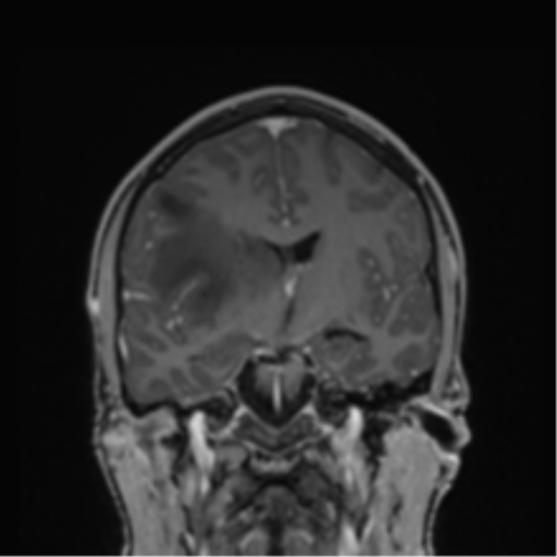 Cerebral abscess (Radiopaedia 60342-68009 H 26).png
