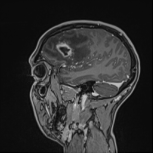File:Cerebral abscess (Radiopaedia 60342-68009 J 43).png