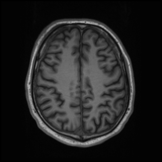 File:Cerebral abscess with ventriculitis (Radiopaedia 78965-91878 Axial T1 35).jpg