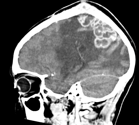 Cerebral abscesses (Radiopaedia 70458-80568 Sagittal Contrast 20).jpg
