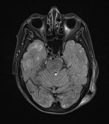 File:Cerebral amyloid angiopathy-related inflammation (Radiopaedia 74836-85849 Axial FLAIR 10).jpg