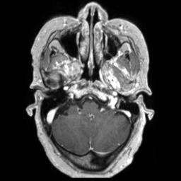 Cerebral amyloid angiopathy (Radiopaedia 29129-29518 Axial T1 C+ 33).jpg