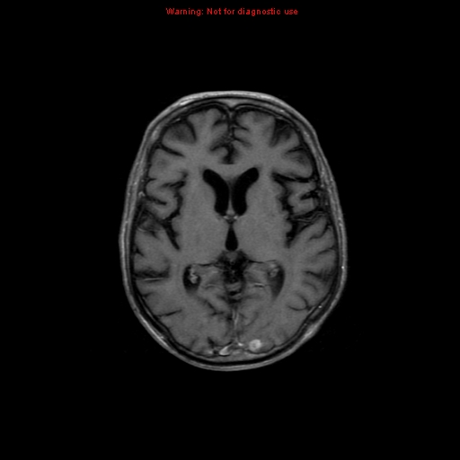 File:Cerebral and orbital tuberculomas (Radiopaedia 13308-13311 Axial T1 C+ 11).jpg