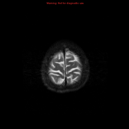 File:Cerebral and orbital tuberculomas (Radiopaedia 13308-13311 Axial T2 20).jpg