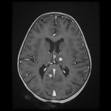 Cerebral and spinal tuberculosis (Radiopaedia 90489-107837 Axial T1 C+ 115).jpg