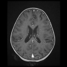 Cerebral and spinal tuberculosis (Radiopaedia 90489-107837 Axial T1 C+ 123).jpg