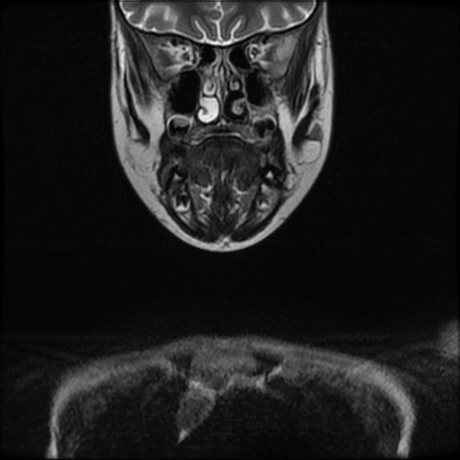 File:Cerebral and spinal tuberculosis (Radiopaedia 90489-107838 Coronal 19).jpg