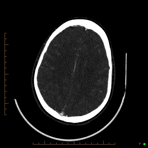 Cerebral arteriovenous malformation (AVM) (Radiopaedia 78162-90706 Axial CTA 194).jpg