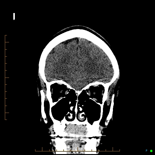 File:Cerebral arteriovenous malformation (AVM) (Radiopaedia 78162-90706 Coronal non-contrast 24).jpg