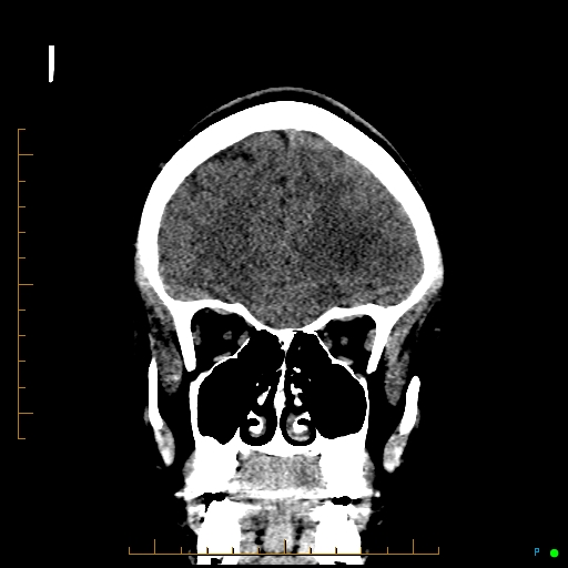 Cerebral arteriovenous malformation (AVM) (Radiopaedia 78162-90706 Coronal non-contrast 26).jpg