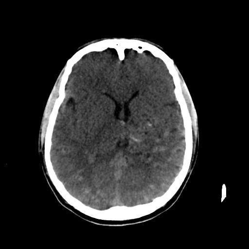 Cerebral arteriovenous malformation (Radiopaedia 28518-28759 Axial non-contrast 37).jpg