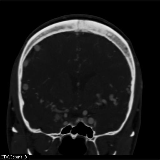 File:Cerebral arteriovenous malformation (Radiopaedia 28518-28759 C 31).jpg