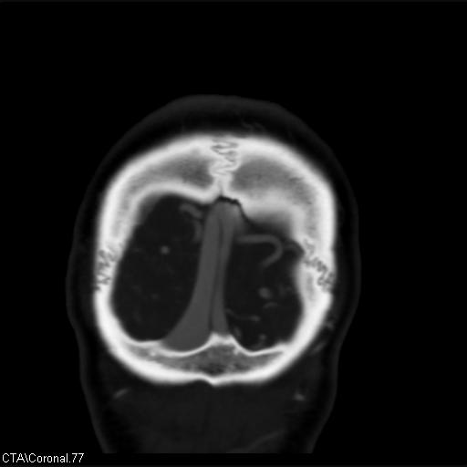 File:Cerebral arteriovenous malformation (Radiopaedia 28518-28759 C 77).jpg