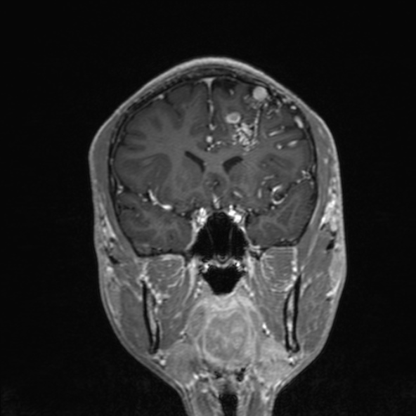 Cerebral arteriovenous malformation (Radiopaedia 30198-30813 F 24).jpg
