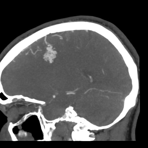 Cerebral arteriovenous malformation (Radiopaedia 39259-41505 Sagittal 23).png
