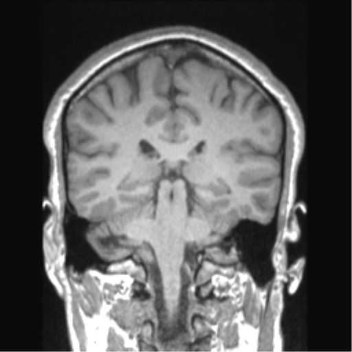 Cerebral arteriovenous malformation (Radiopaedia 39259-41506 Coronal T1 38).png