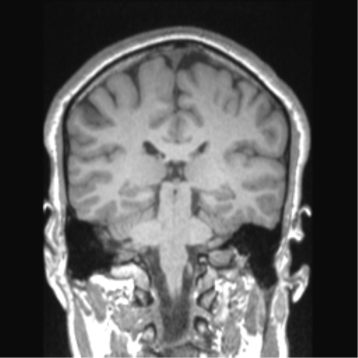 Cerebral arteriovenous malformation (Radiopaedia 39259-41506 Coronal T1 39).png