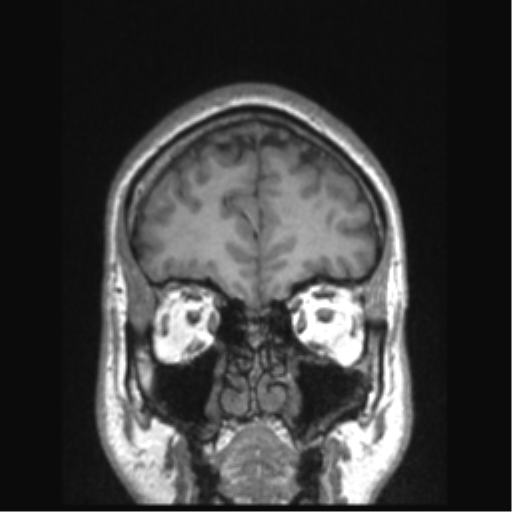 Cerebral arteriovenous malformation (Radiopaedia 39259-41506 Coronal T1 76).png