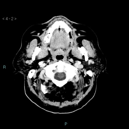 File:Cerebral arteriovenous malformation (Radiopaedia 40528-43125 Axial C+ delayed 2).jpg