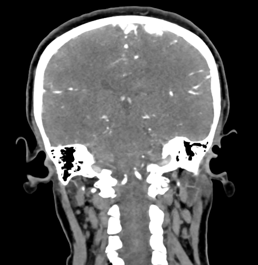 Cerebral arteriovenous malformation (Radiopaedia 73830-84645 C 61).jpg