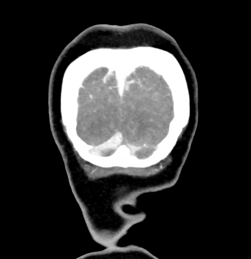 Cerebral arteriovenous malformation (Radiopaedia 73830-84645 C 91).jpg