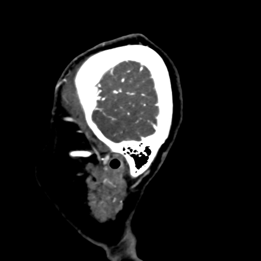 Cerebral arteriovenous malformation (Radiopaedia 73830-84645 Sagittal C+ delayed 84).jpg