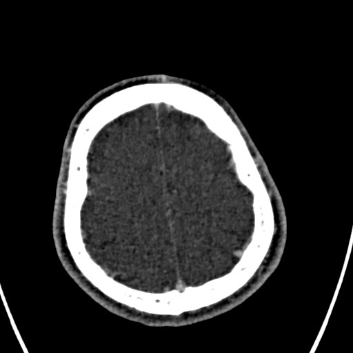 Cerebral arteriovenous malformation (Radiopaedia 78188-90746 Axial C+ delayed 145).jpg