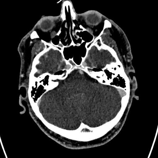 Cerebral arteriovenous malformation (Radiopaedia 78188-90746 Axial C+ delayed 42).jpg