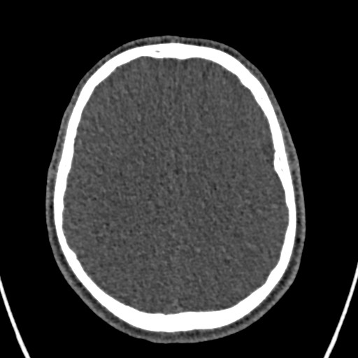 Cerebral arteriovenous malformation (Radiopaedia 78188-90746 Axial non-contrast 121).jpg