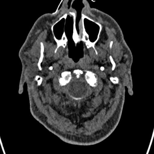 File:Cerebral arteriovenous malformation (Radiopaedia 78188-90746 Axial non-contrast 8).jpg