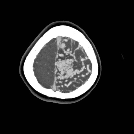 File:Cerebral arteriovenous malformation (Radiopaedia 79677-92888 A 53).jpg