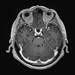 Cerebral arteriovenous malformation (Radiopaedia 84015-99245 Axial T1 C+ 58).jpg