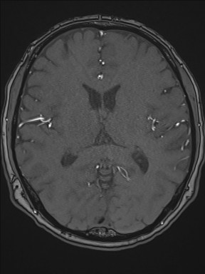 Cerebral arteriovenous malformation (Radiopaedia 84015-99245 Axial TOF 134).jpg
