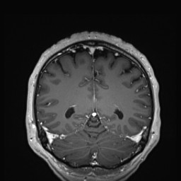 Cerebral arteriovenous malformation (Radiopaedia 84015-99245 Coronal T1 C+ 120).jpg