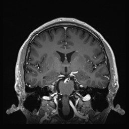 Cerebral arteriovenous malformation (Radiopaedia 84015-99245 Coronal T1 C+ 77).jpg