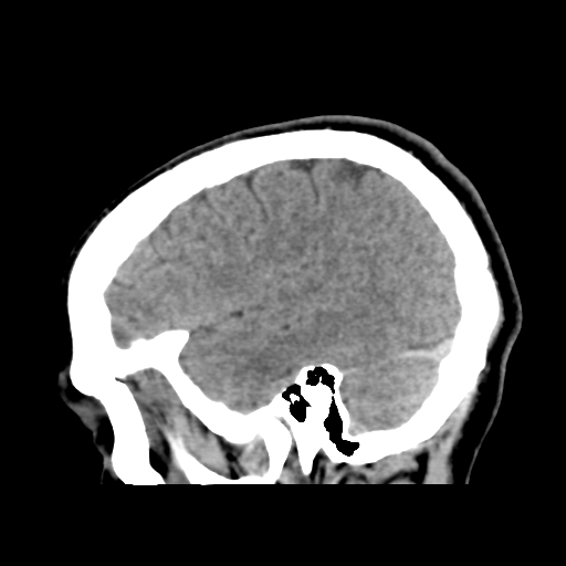 File:Cerebral arteriovenous malformation (Spetzler-Martin grade 2) (Radiopaedia 41262-44076 A 17).png
