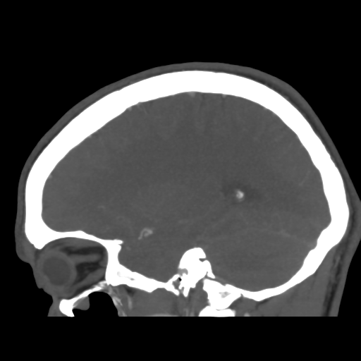 Cerebral arteriovenous malformation (Spetzler-Martin grade 2) (Radiopaedia 41262-44076 G 37).png