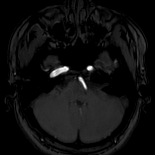 Cerebral arteriovenous malformation at posterior body of corpus callosum (Radiopaedia 74111-84925 Axial MRA 38).jpg