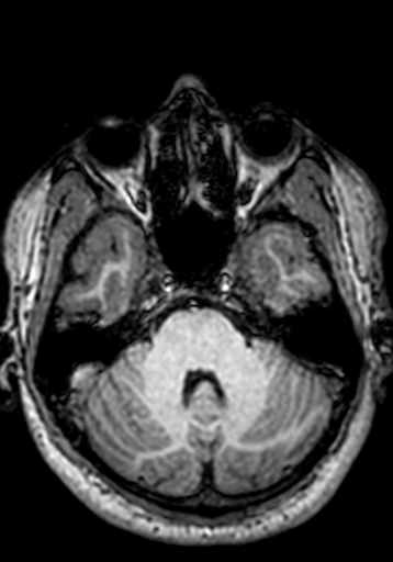 Cerebral arteriovenous malformation at posterior body of corpus callosum (Radiopaedia 74111-84925 Axial T1 232).jpg