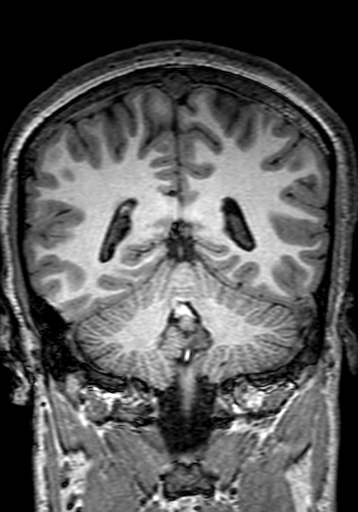 Cerebral arteriovenous malformation at posterior body of corpus callosum (Radiopaedia 74111-84925 Coronal T1 234).jpg