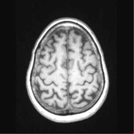 Cerebral arteriovenous malformation with hemorrhage (Radiopaedia 34422-35737 Axial T1 61).png